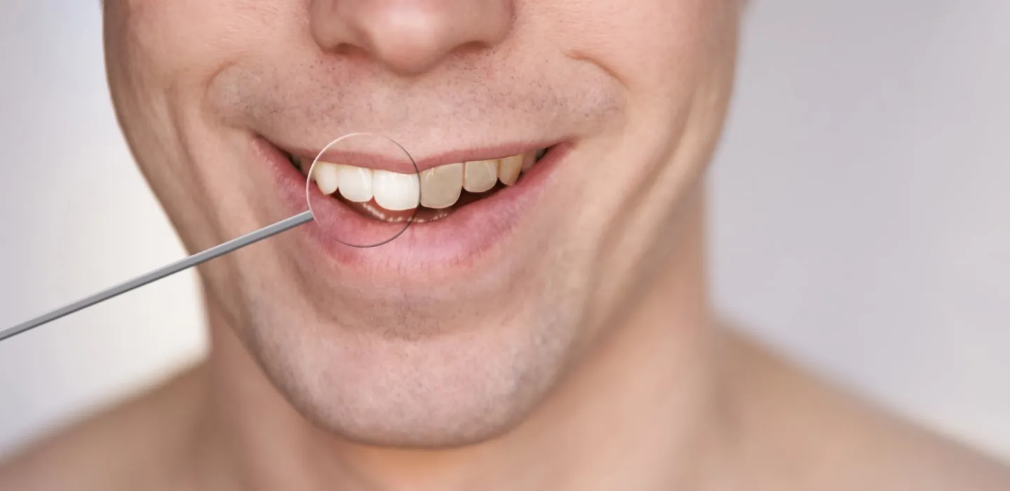 Mann mit geöffneten Mund und verfärbten Zähnen